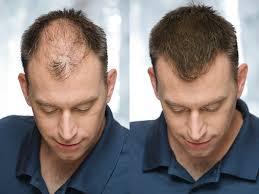 Causas y soluciones para la caída del cabello.